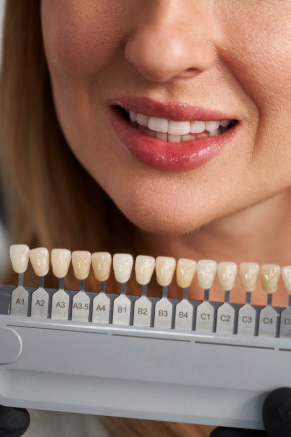 teeth whitening