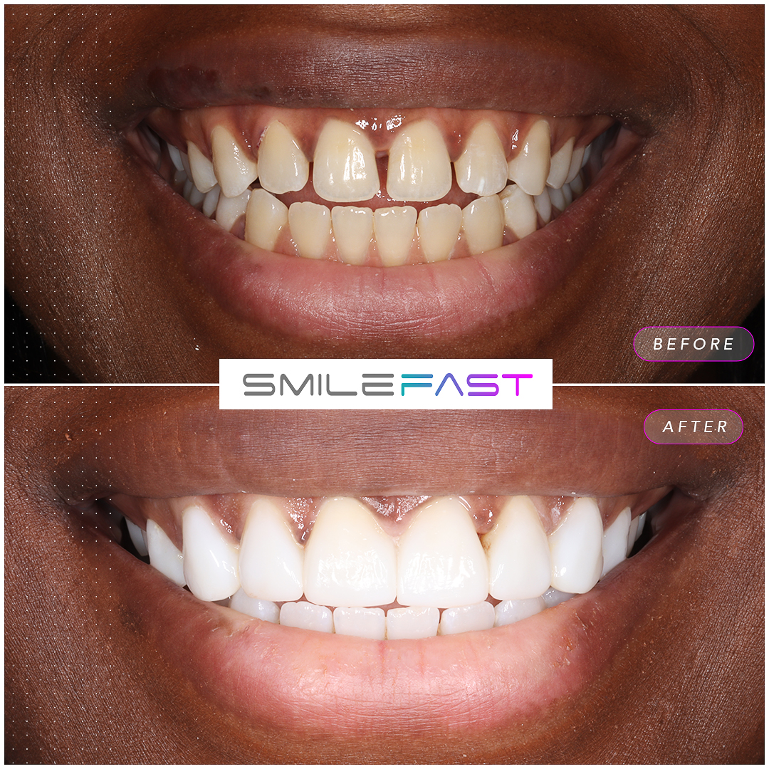 Before and after smile makeover at Aura Dental in Sandy, case two