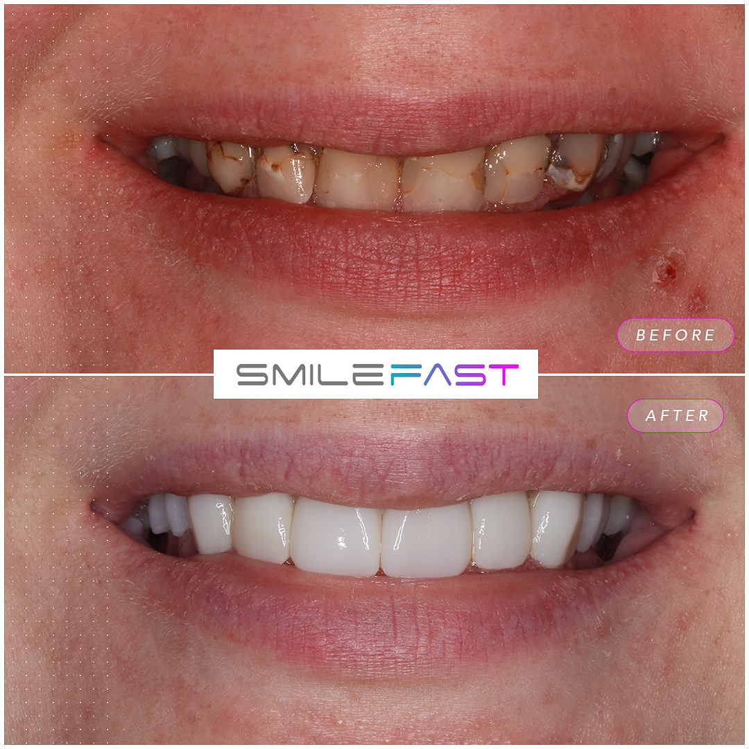 Before and after smile makeover at Aura Dental in Sandy, case five