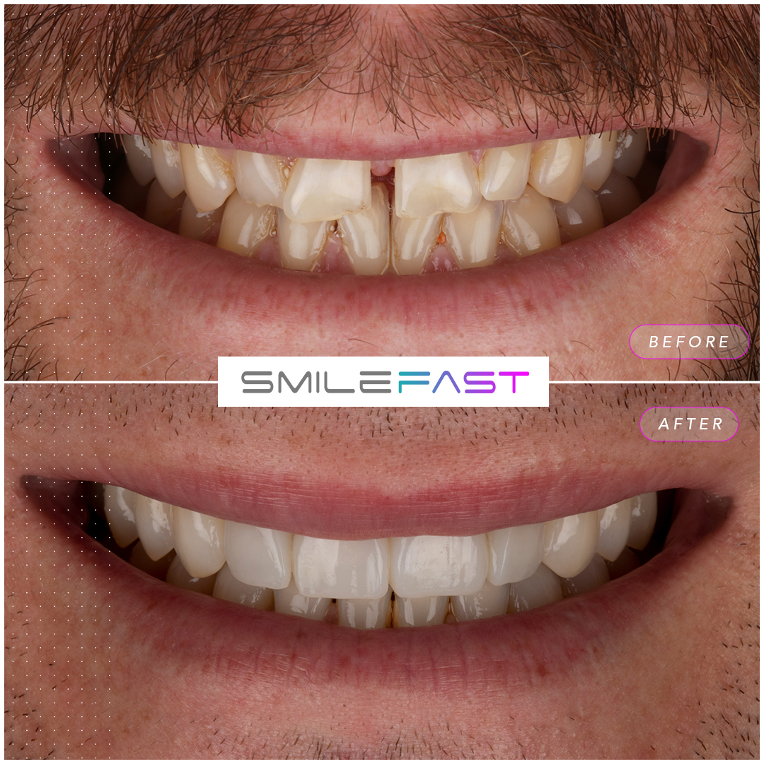 Before and after smile makeover at Aura Dental in Sandy, case four