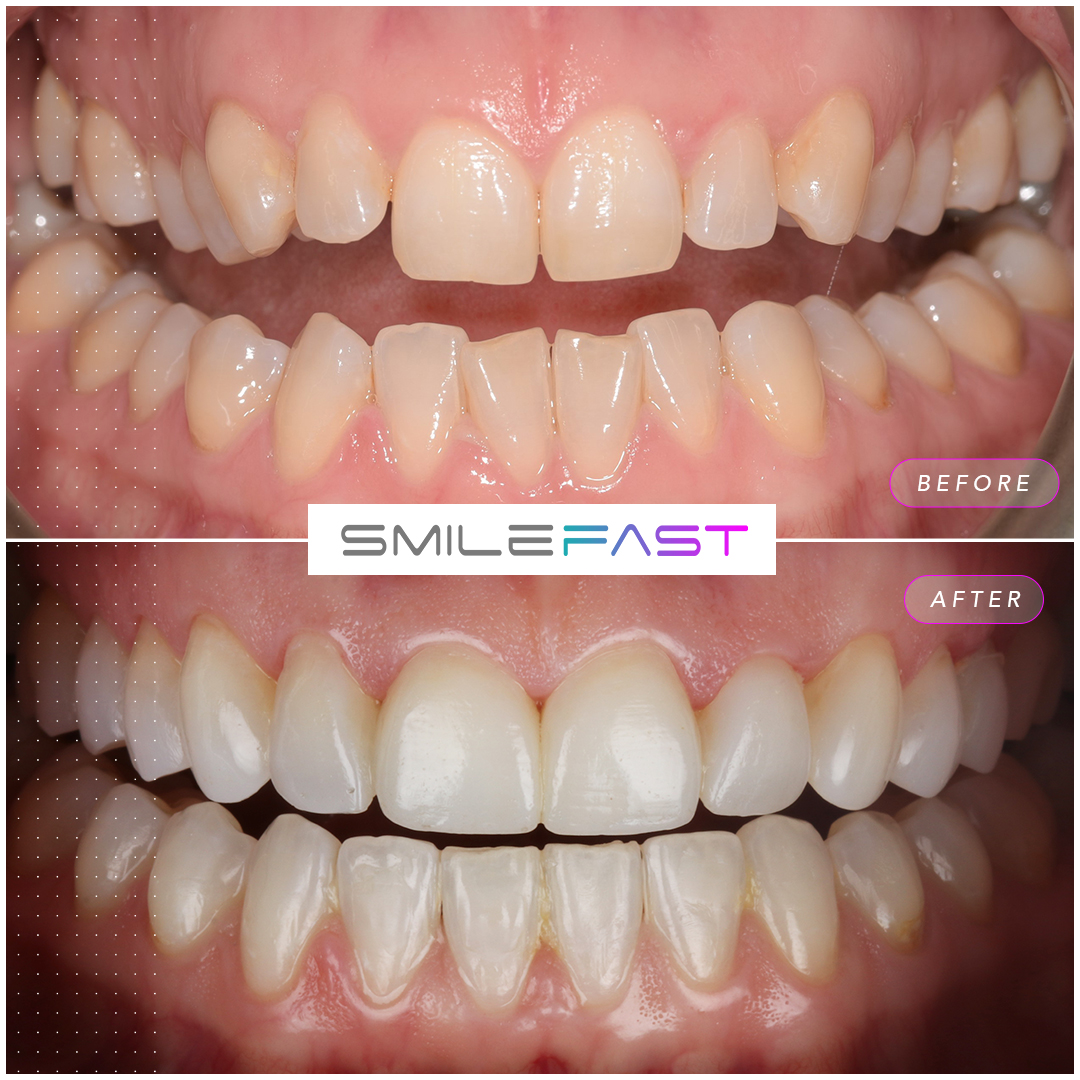 Before and after smile makeover at Aura Dental in Sandy, case one