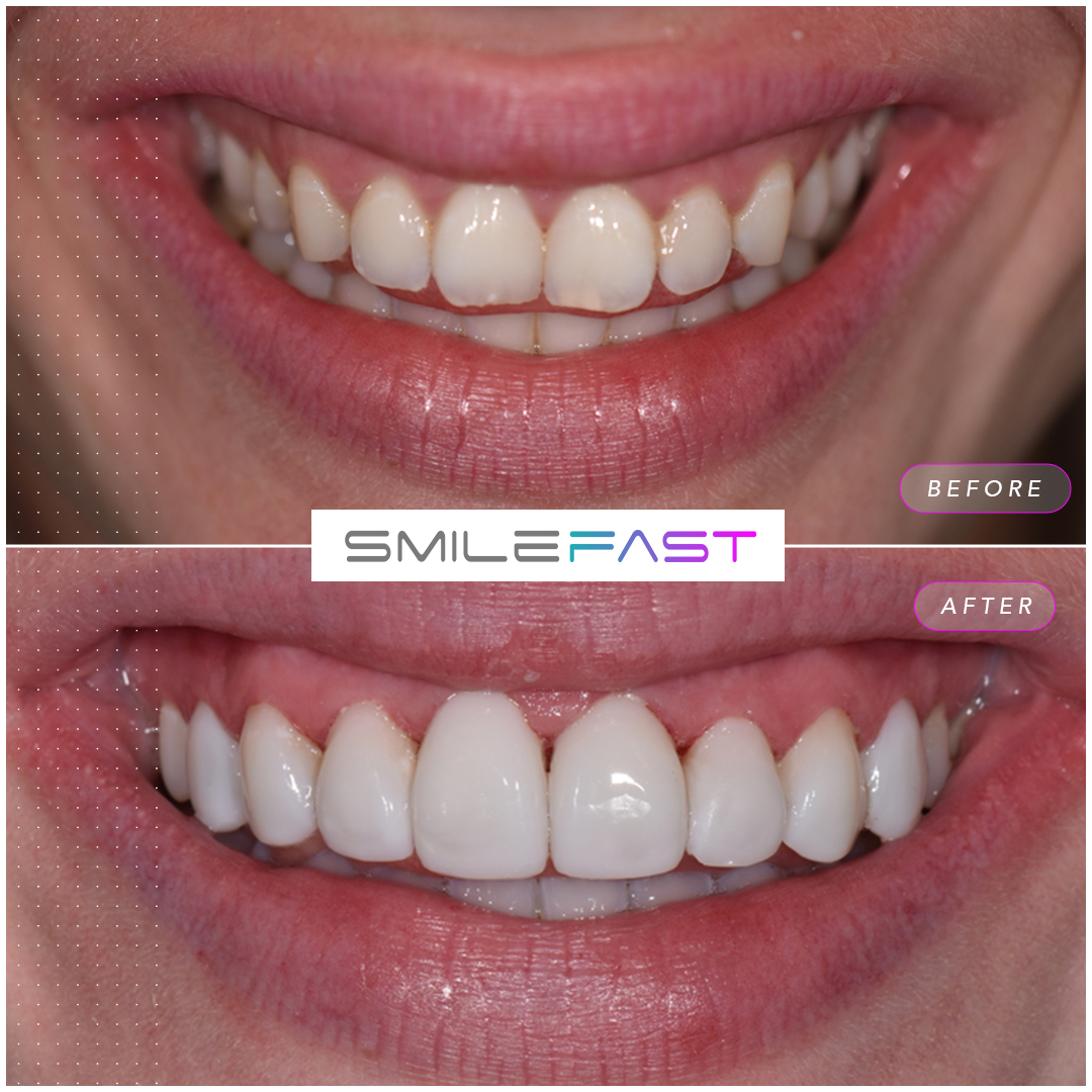 Before and after smile makeover at Aura Dental in Sandy, case three